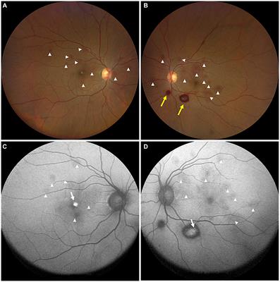 Multimodal imaging shows acute multilayered retinal hemorrhages in heatstroke–a rare case report